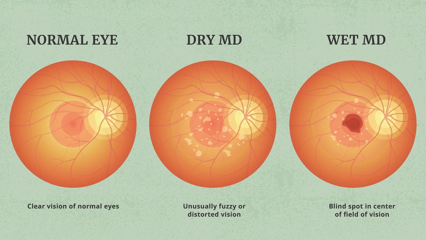 AMD Explained Tips for Safeguarding Your Vision OBN